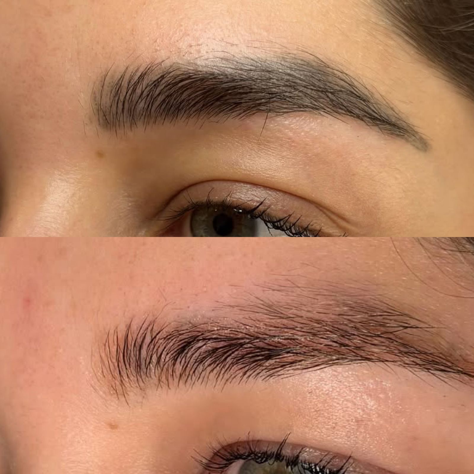 Resultado de remoção a laser